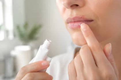 What Kills Cold Sores Fast Treatments That Help